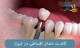کاشت دندان اقساطی در شیراز + ایمپلنت اقساط در شیراز