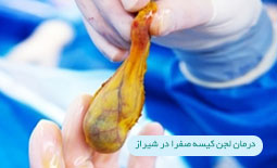 درمان لجن کیسه صفرا در شیراز