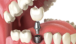 لیست دندانپزشکان متخصص ایمپلنت در گرگان