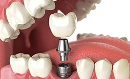 لیست دندانپزشکان متخصص ایمپلنت در کیش
