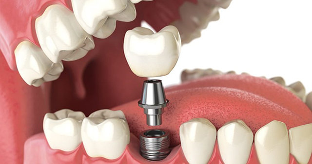 لیست دندانپزشکان متخصص ایمپلنت در بجنورد