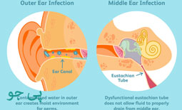عفونت گوش میانی چیست؟ 