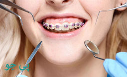 ارتودنسی دندان چیست و چگونه انجام می شود؟