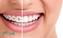 سن مناسب ارتودنسی دندانها چه سنی می باشد؟ 