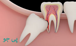 عصب کشی دندان چه زمانی لازم است و چگونه انجام میشود؟