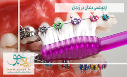 ارتودنسی دندان در زنجان