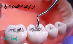 پر کردن دندان در شیراز