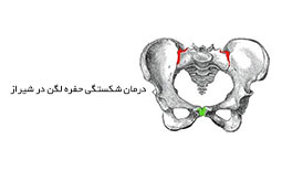 درمان شکستگی حفره لگن در شیراز