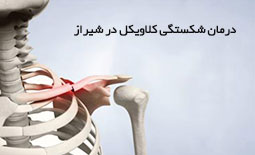 درمان شکستگی کلاویکل در شیراز