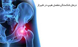 درمان شکستگی مفصل هیپ در شیراز