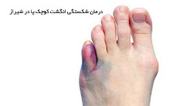 درمان شکستگی انگشت کوچک پا در شیراز