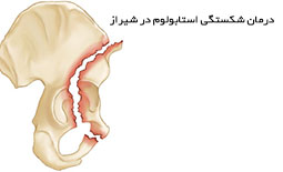 درمان شکستگی استابولوم در شیراز