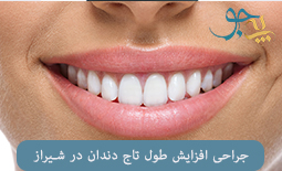 جراحی افزایش طول تاج دندان در شیراز