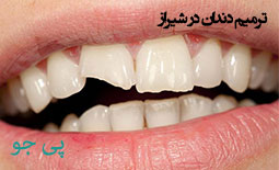 ترمیم دندان در شیراز