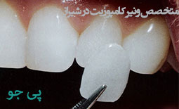 بهترین دکتر کامپوزیت در شیراز + مرجع دندانپزشکان متخصص کامپوزیت شیراز