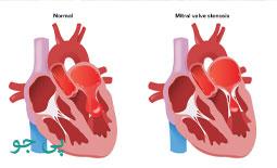 روش های درمان تنگی دریچه میترال