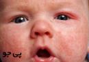 عوارض سرخک برای تمامی اعضای بدن