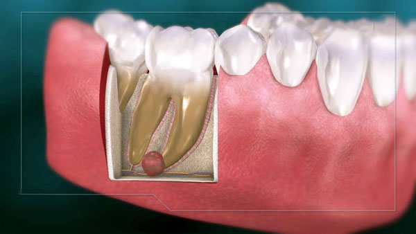 اطلاعاتی درباره کیست دندان