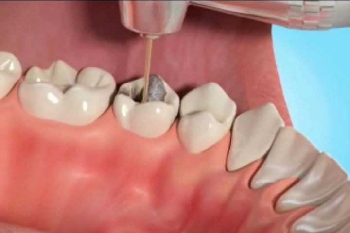 درباره عصب کشی دندان چه می‌دانید؟