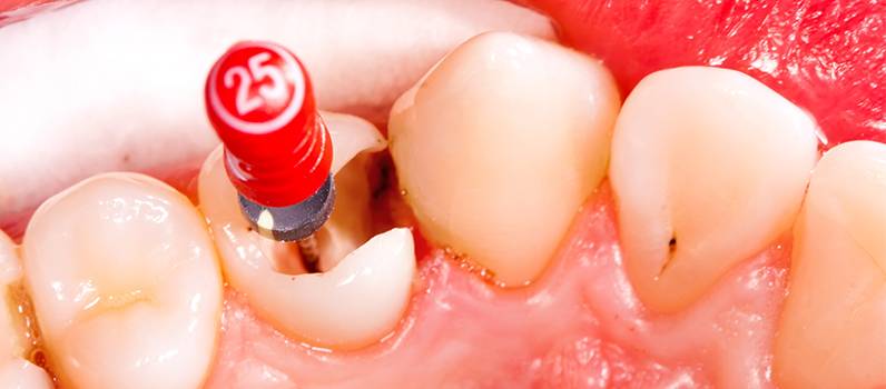 درباره عصب کشی دندان چه می‌دانید؟