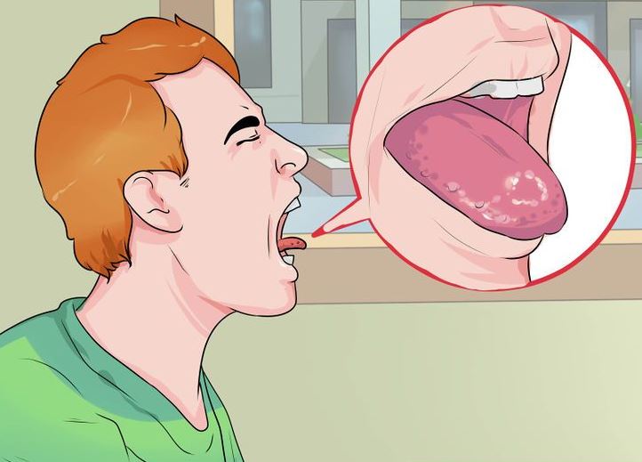 درمان سوختگی زبان و گلو
