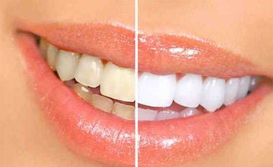 زردی دندان ها نشانه چیست؟