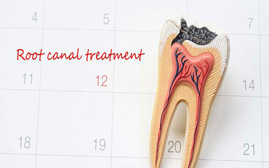 عصب کشی دندان چیست؟