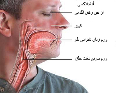 علل و علائم بیماری آنافيلاكسی ( شوک آلرژیک )