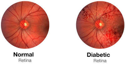 پیشگیری از نابینایی دیابتی با این روش ها