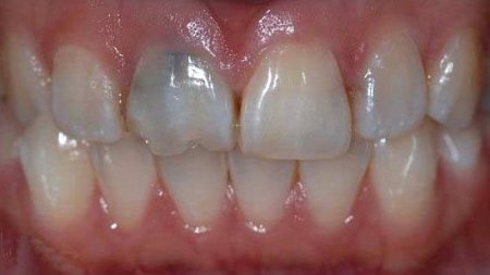 علت سیاه شدن دندان ، پیشگیری و درمان آن