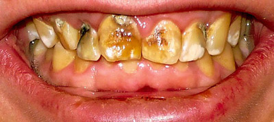 فلوروزیس دندانی چیست؟
