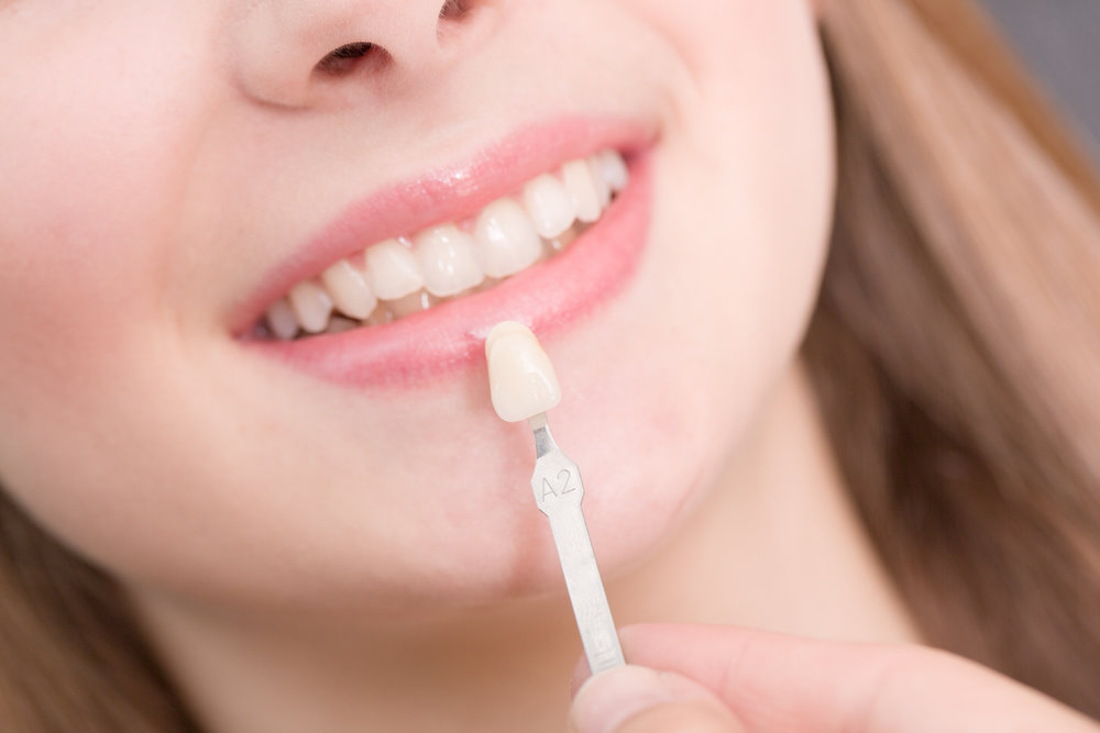 لمینت دندان چیست؟ انواع لمینت دندان ، مزایا و معایب آن