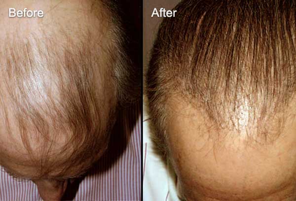 علت ریزش مو در مردان و درمان آن