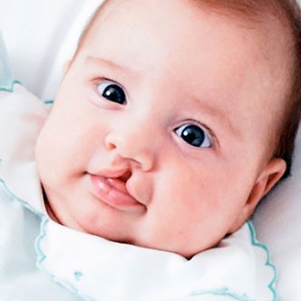 درمان لب شکری در نوزادان