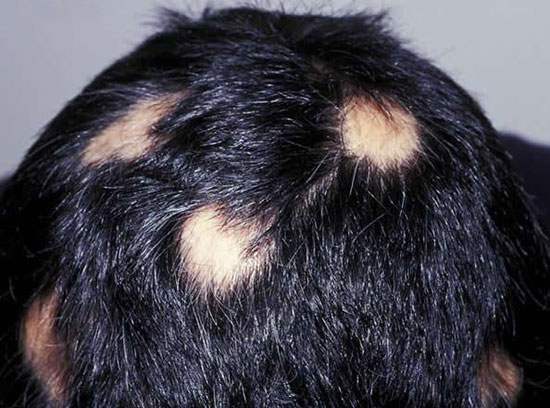 نکاتی در مورد ریزش سکه ای مو و راه های درمان