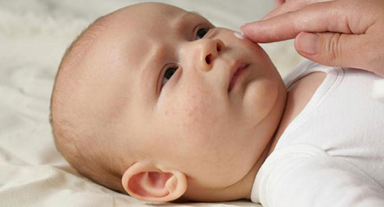 روش های پیشگیری از خشکی پوست نوزادان