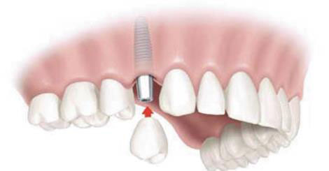 نکاتی در رابطه با ایمپلنت دندان ها