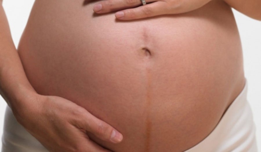 خط لینا نیگرا در بارداری چیست؟