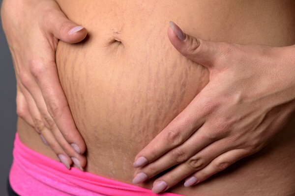 چگونه ترک های ناشی از بارداری را کاهش دهیم؟