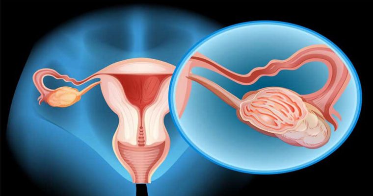 آنچه در مورد سرطان تخمدان زنان باید بدانیم