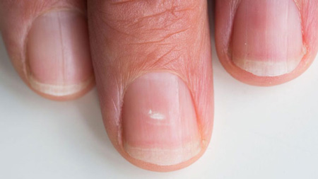 دلایل ایجاد لکه های سفید روی ناخن و درمان آن