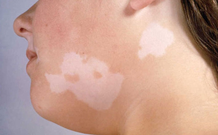 دلایل ایجاد لکه های سفید بر روی پوست