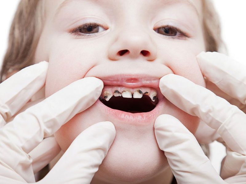 نقش مواد غذایی در پوسیدگی دندان کودکان