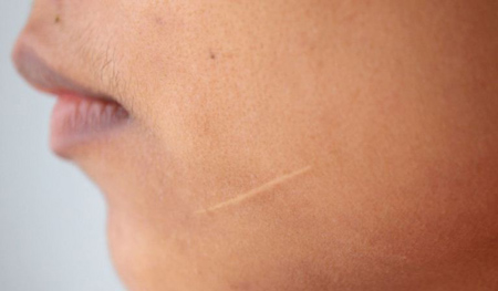 راه هایی برای درمان اسکار پوست