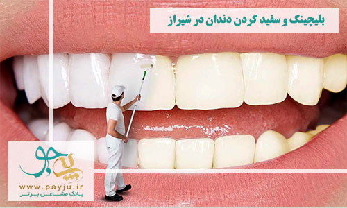 متخصص بلیچینگ و سفید کردن دندان در شیراز