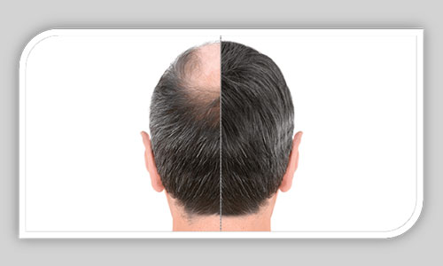 بررسی شرایط کاشت موی مجدد - عمل زیبایی کاشت مو