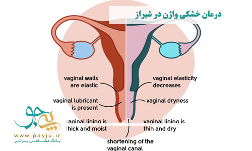 درمان خشکی واژن در شیراز