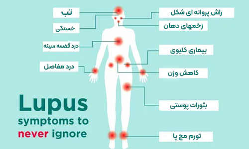 علائم و نشانه های بیماری لوپوس چیست؟