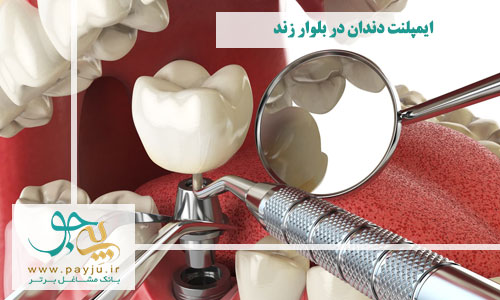 ایمپلنت دندان در بلوار زند شیراز