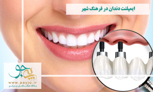  بهترین دندانپزشکان ایمپلنت دندان فرهنگ شهر شیراز